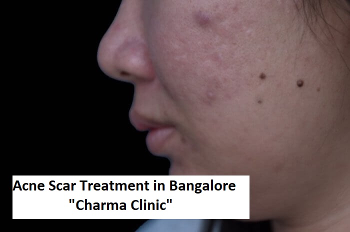 Acne Scar: Know About Types & Treatments